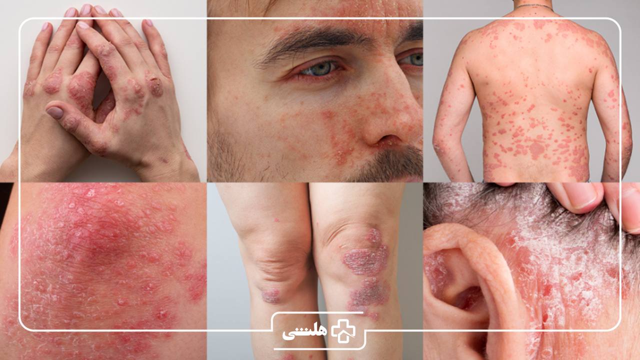 پسوریازیس باعث چه بیماری میشود؟