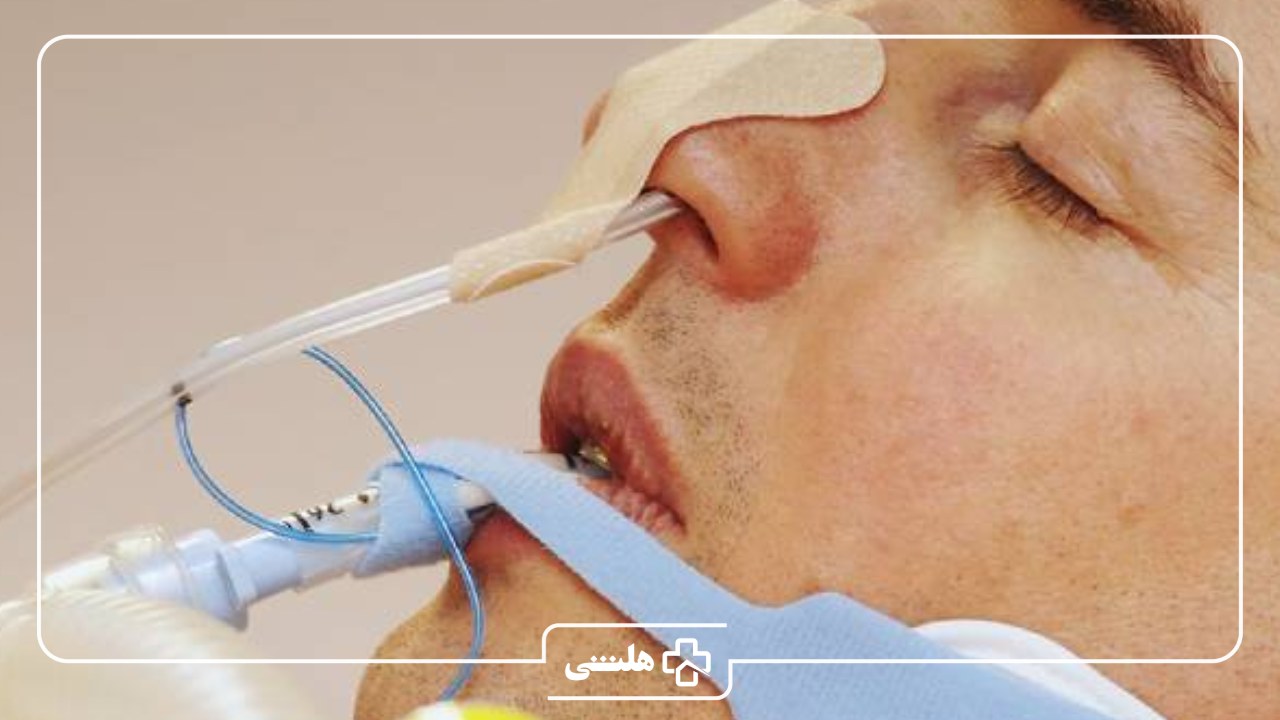 لوله تغذیه بیمار بستری در منزل